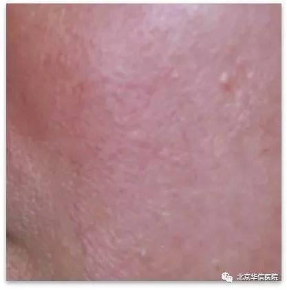 光子嫩肤唤醒肌肤活力重塑娇颜,光子嫩肤让你焕颜一新