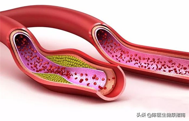 高血压同型半胱氨酸高补哪种叶酸 (高血压同型半胱氨酸多少要吃叶酸)