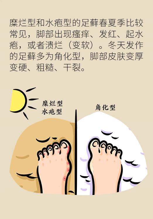 脚气脚痒根治的最好的方法,脚气脚痒怎么根治最快最有效