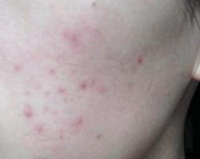 这才是祛痘印最正确的打开方式,全球公认最有效的祛痘印方法