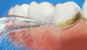 种植牙价格会不会越来越便宜,现在种植牙真的这么便宜吗