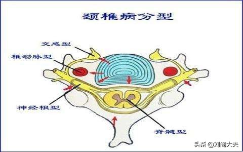 颈椎疼痛应该怎么治疗才断根,颈椎病疼痛难忍小妙招