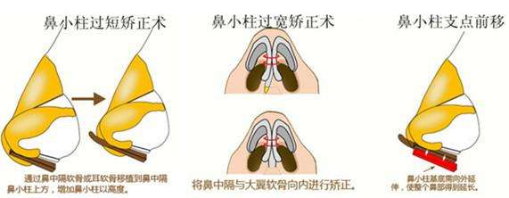 鼻小柱缺陷怎么治,鼻小柱和鼻翼不在一条水平线