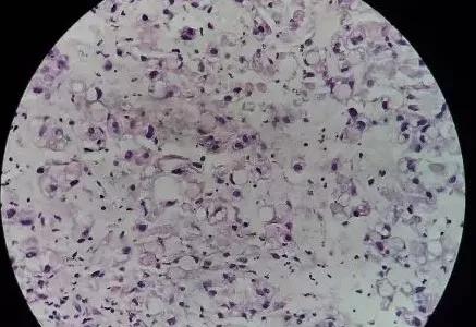 女子体检检查胃癌晚期,女孩体检发现癌症后续