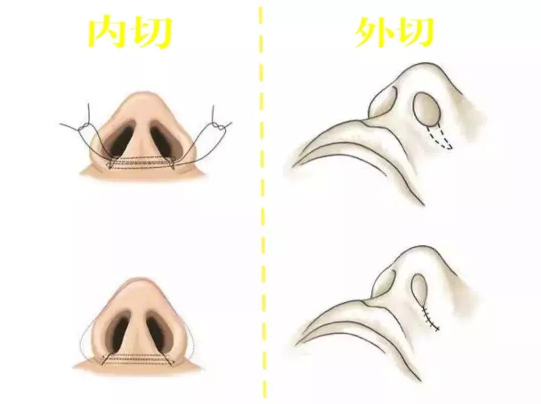 缩小鼻孔最简单有效的方法,怎么自由缩鼻孔