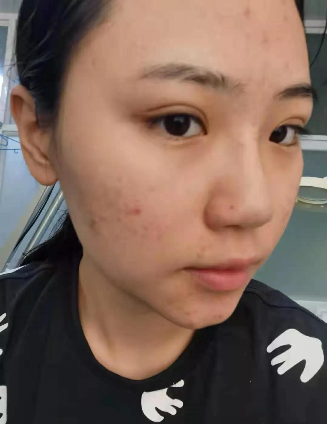 深圳治痘痘皮肤科哪个医院好啊,去皮肤科看痘痘好不好