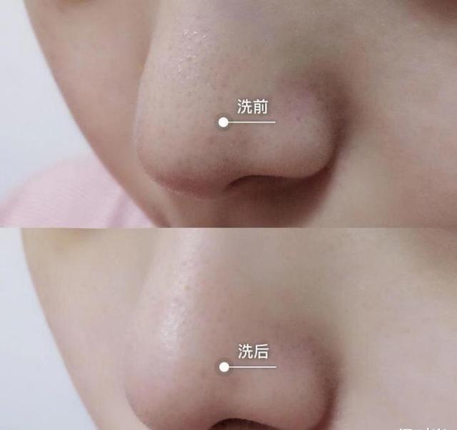 超棒国货去痘痘,祛除痘痘的国货测评