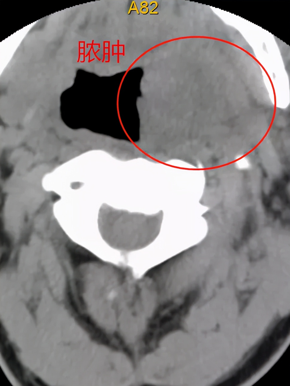 车祸颈椎骨折脱位会不会有后遗症,车祸导致颈椎错位手术风险大吗