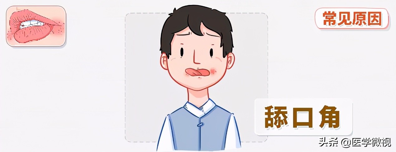 得了嘴角炎怎么办,经常烂嘴角吃什么药好得快