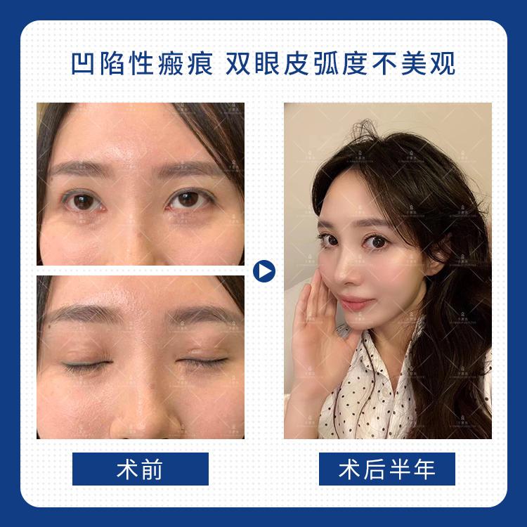 于景浩修复双眼皮图片,于景浩做双眼皮修复怎样