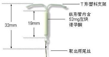 环节育器,避孕环和避孕器