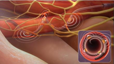 有效降血压药,最新最好降血压新药