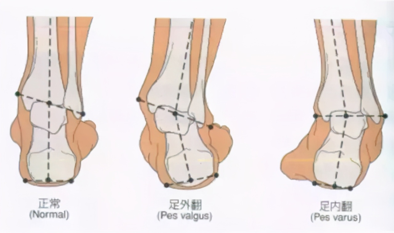 鞋底脚后跟外侧磨损严重怎么回事,鞋外侧磨损是不是和脚踝有关