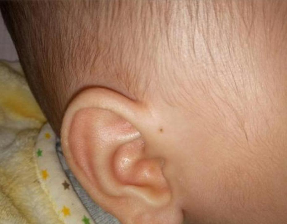 为什么婴儿耳朵上有疙瘩,为什么医生说婴儿耳朵小