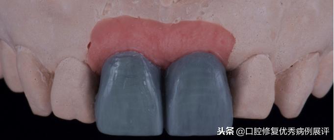 展评优秀病例赏析|Asc全瓷角度基台一体冠进行种植前牙美学修复