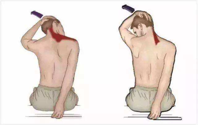 全面解析上交叉综合征，将你的体态问题一锅端