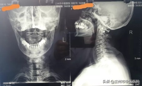 腰椎滑脱手术五十天伤口痛正常吗,银质针能治腰椎滑脱吗