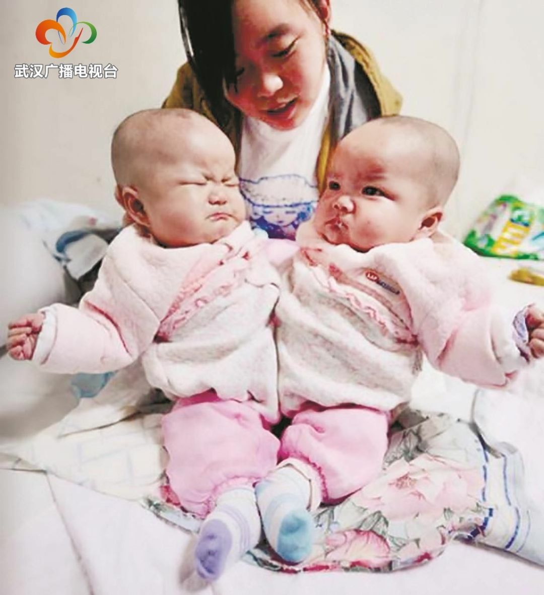 10年前的今天，这对罕见的连体女婴成功“分身”，如今她们牵手上学超暖心