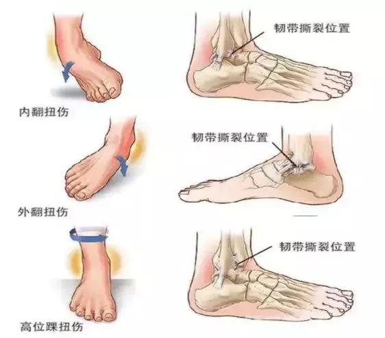 骨科医生治崴脚的日常,骨科林剑浩踝关节扭伤康复动作