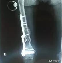 骨折打了钢筋了要取出来吗,骨折打了钢板能定残吗