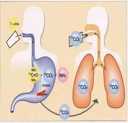 幽门螺旋杆菌呼气试验科普,呼气试验幽门螺旋杆菌有危害吗