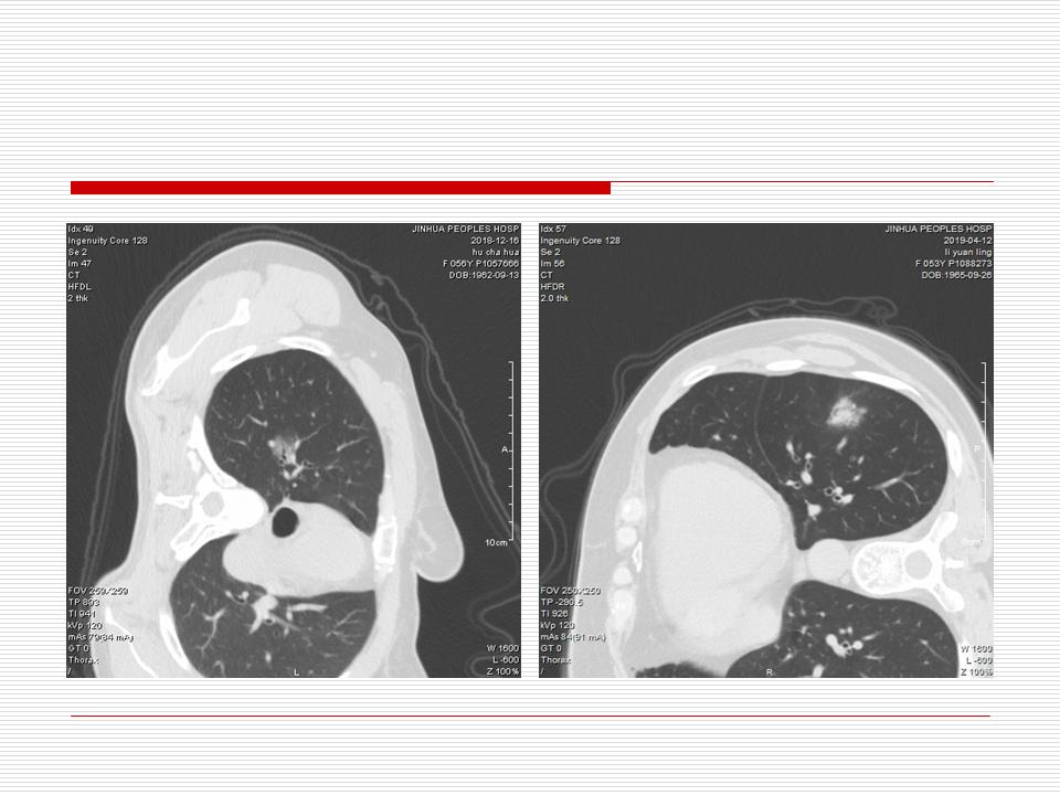 像炎症的肺癌能治好吗,医生说可能是肺癌也可能是炎症