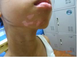 10年白癜风还能治吗,10年白癜风现原形