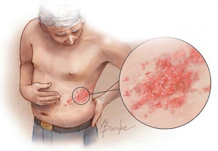 什么容易被误诊为带状疱疹,带状疱疹容易误诊吗