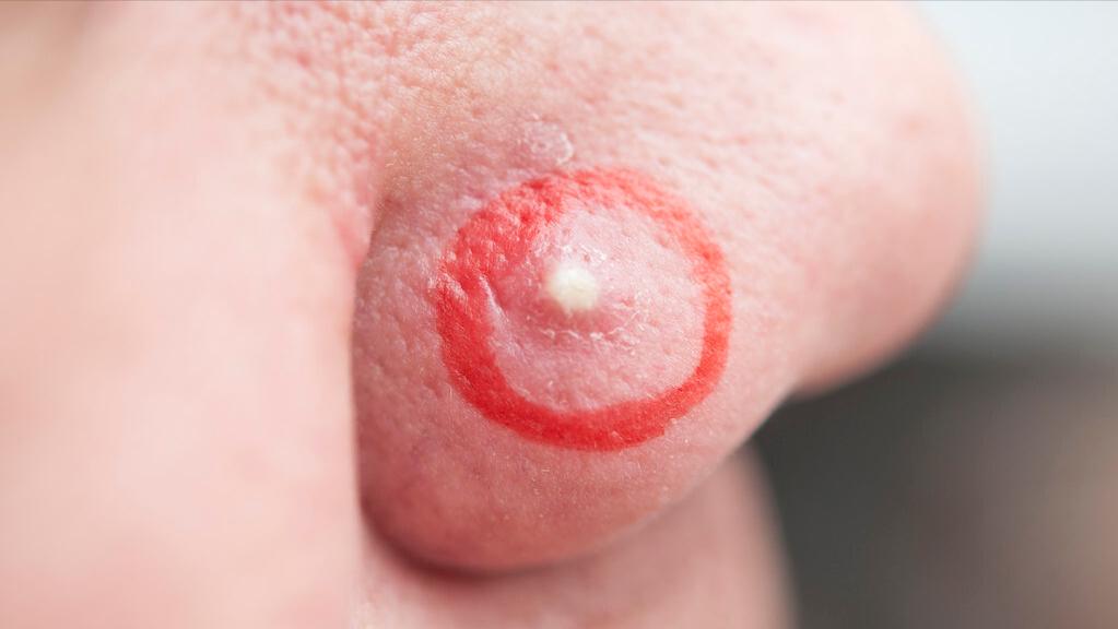 鼻子上挤出来的白色丝状物，看起来像一条虫子，是螨虫吗？