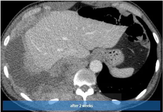 胸壁疼痛的典型特征,临床诊断胸痛是什么意思