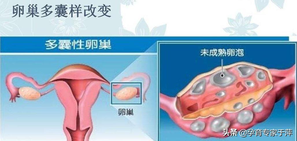 于萍:多囊卵巢综合征怎么治?看看这2个病例就知道了