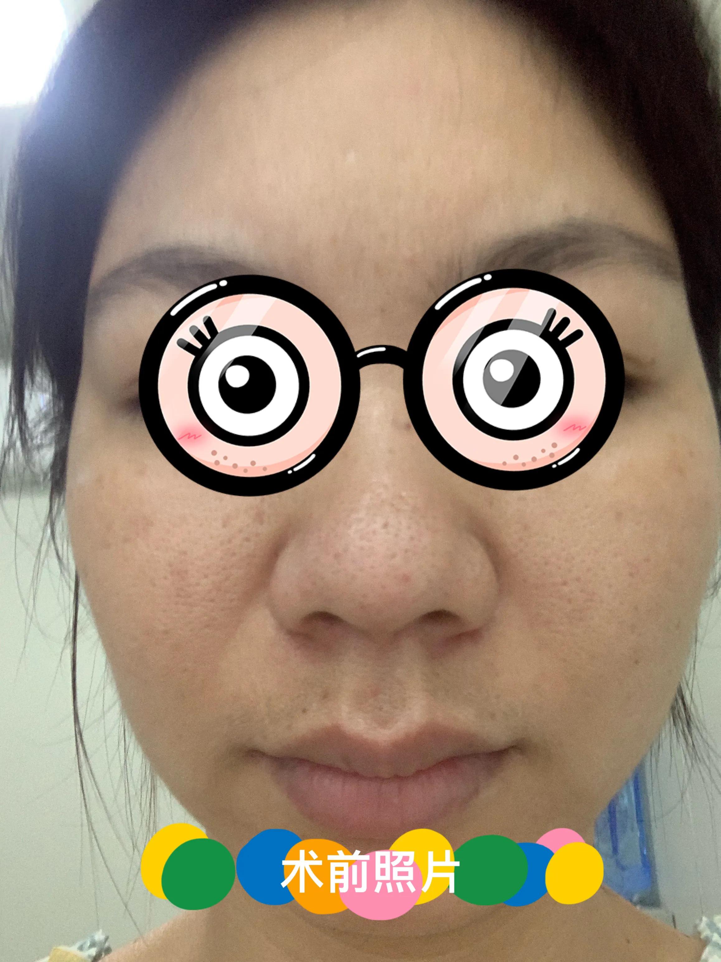 我的祛痘全过程,我的激光祛斑历程