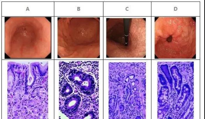 慢性浅表性胃炎是由什么引起来的,慢性浅表性胃炎的症状和如何治疗