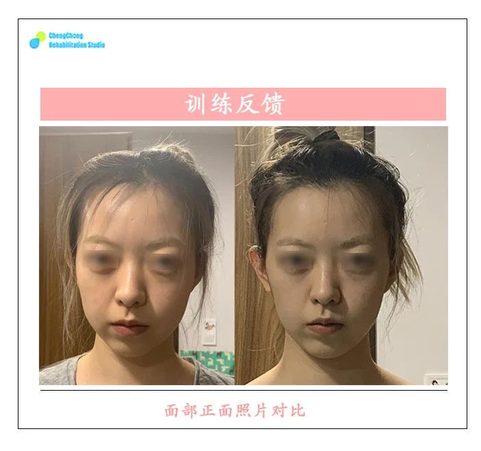 左脸右脸不像同一个人,左右脸很明显的不对称怎么改善