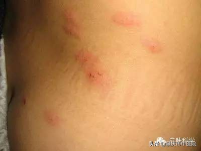 解读八种夏天易发皮肤病,3种秋季高发皮肤病