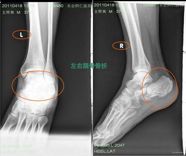 脚跟骨折恢复了怎么练习走路,跟骨骨折保守治疗100天多走路好吗