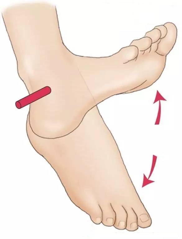 崴脚后怎么防止形成血栓,崴脚后引起血栓有什么症状