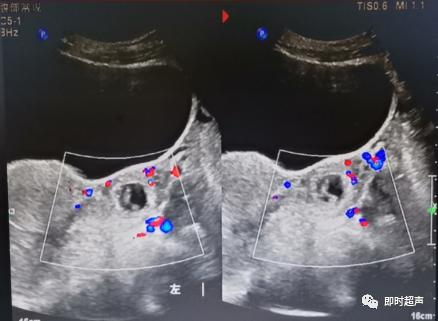 宫外孕的烦恼,你经历过宫外孕吗
