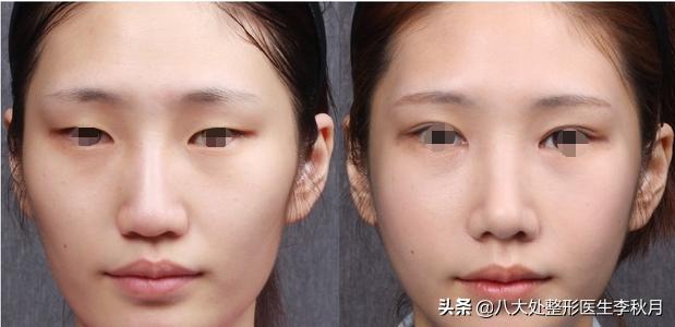 哪些男女明星双眼皮是割的,娱乐圈双眼皮男明星