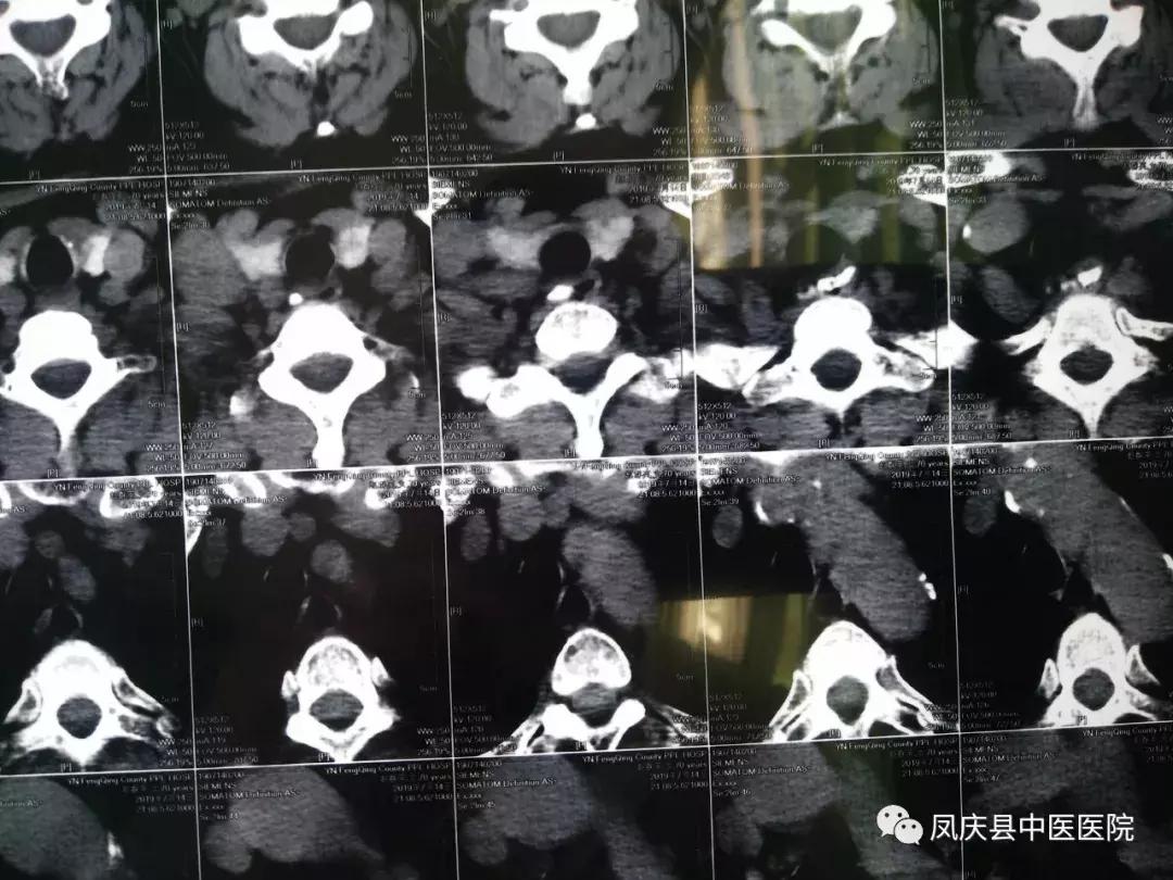 凤庆中医：谨慎“吃鸡”，食管异物取出化危急