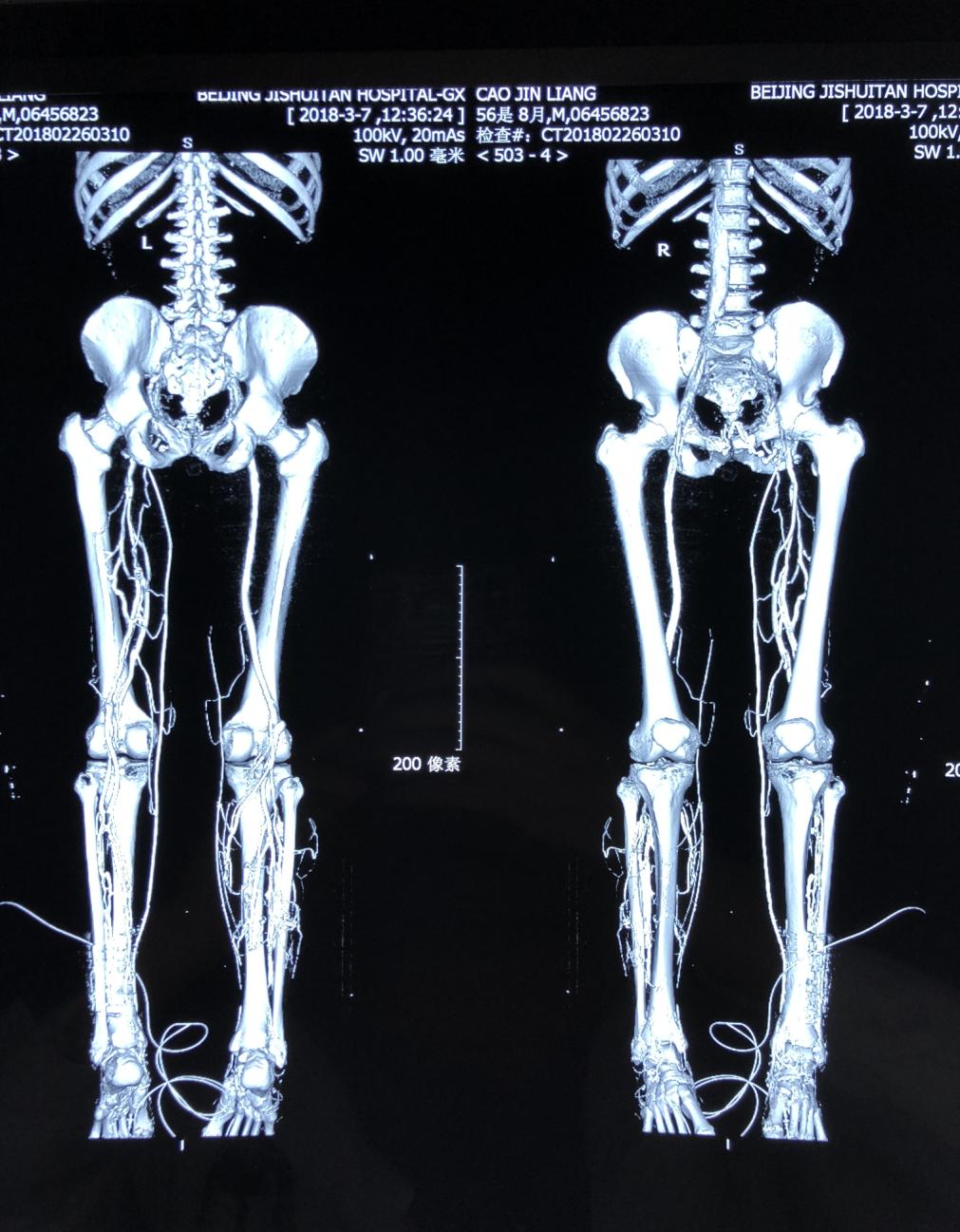 老烂腿如何治,老烂腿怎么回事