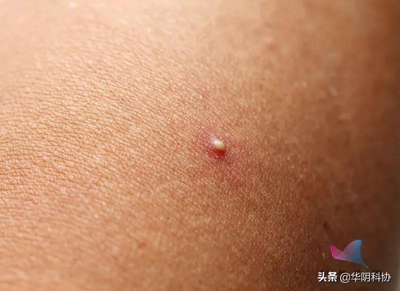 后背粉刺疙瘩怎么去除,后背小米粒疙瘩怎么去除