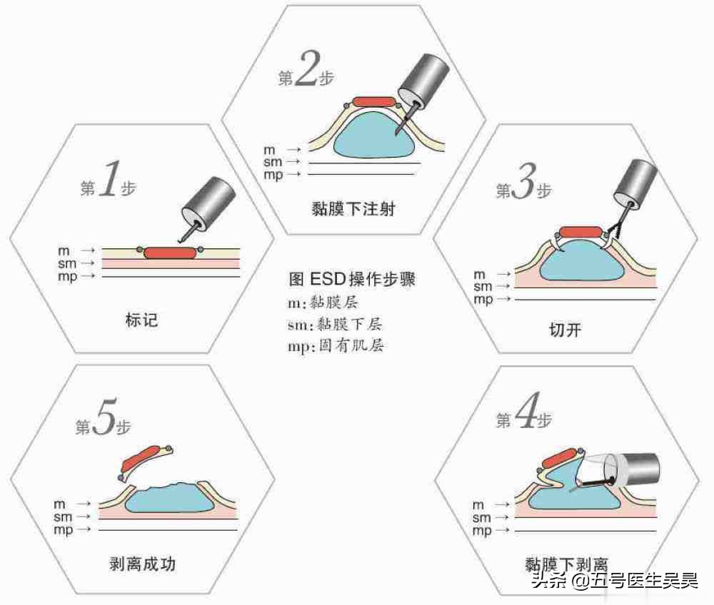 肠道长了“息肉”不要怕，搞清楚这6个问题，医生都给你点赞