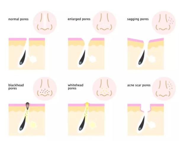 毛孔粗大如何改善真实有效,毛孔粗大收缩毛孔最科学的方法