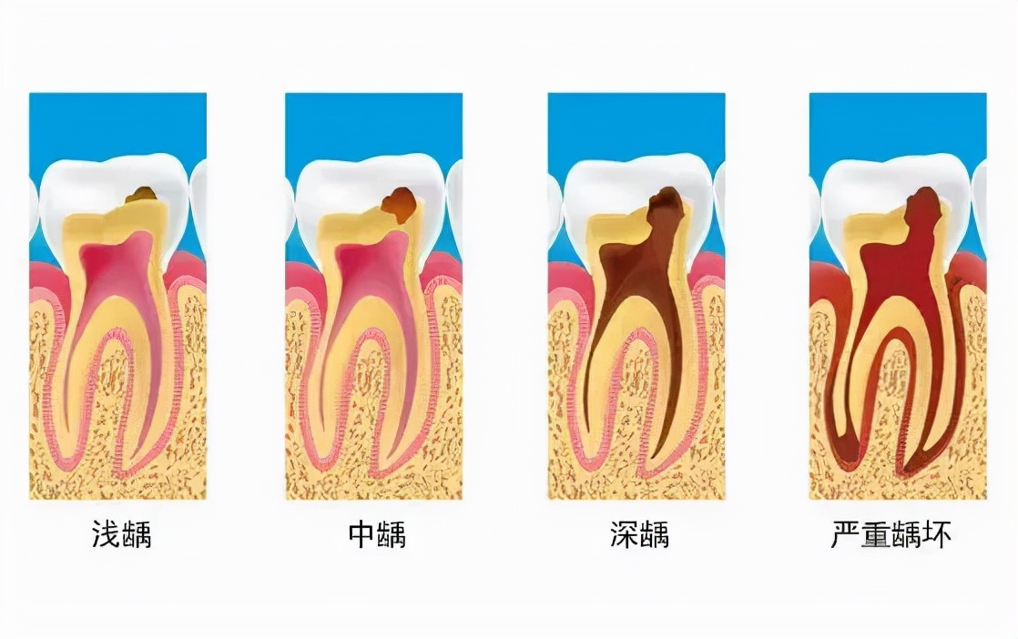 牙齿做根管治疗后疼痛要拔掉吗,牙齿发黑疼痛要拔掉吗