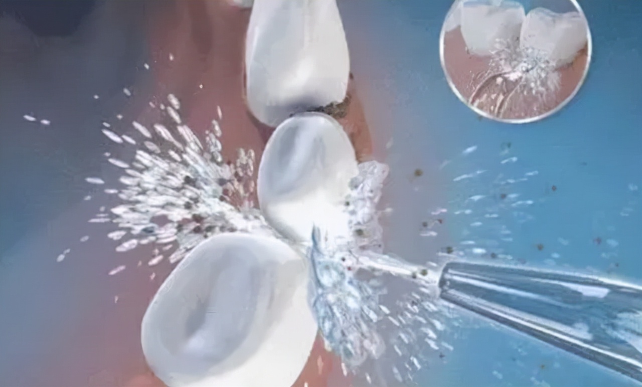 牙结石牙缝大自己脱落小妙招,不小心把牙缝的牙结石抠掉了