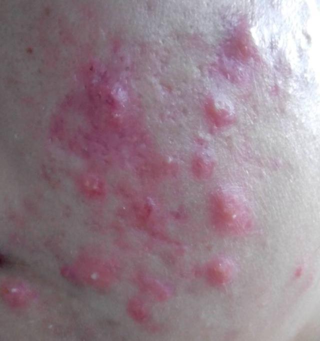 我的战痘历程简介,战痘路上的心酸史