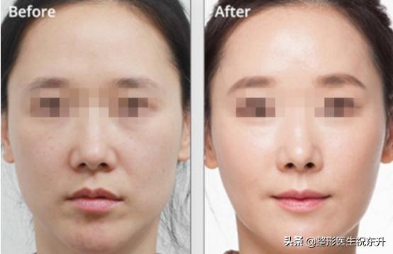 面部松弛做超声刀还是热玛吉,35岁面部松弛是选线雕还是热玛吉