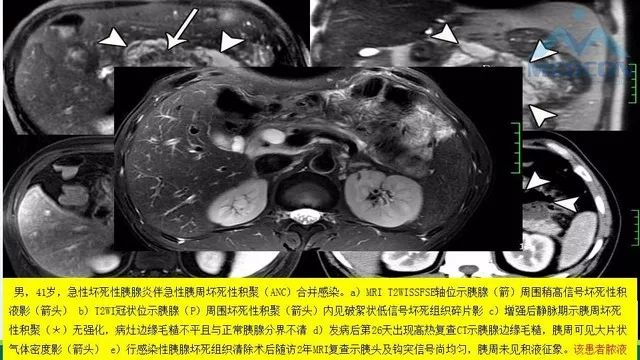 急性胰腺炎的护理措施,急性胰腺炎影像与临床