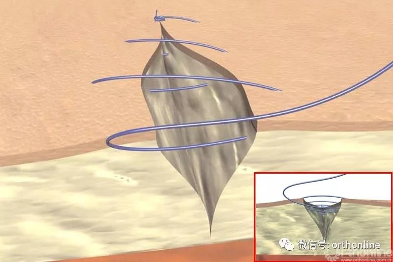 常用的手术缝合方法图,临床常见常用伤口缝合方法